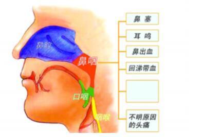 鼻咽癌早期症状颈淋巴结肿大耳鸣耳塞鼻涕带血